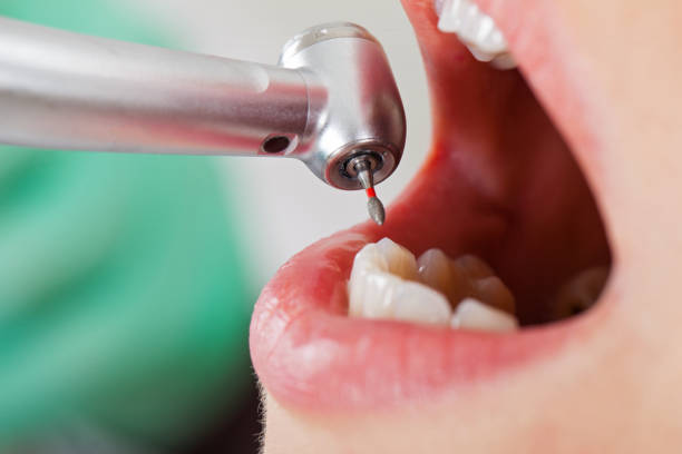 Best Emergency Wisdom Teeth Removal in World Golf Village, FL